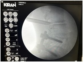 SOPINE FIXATION C ARM IMAGE 